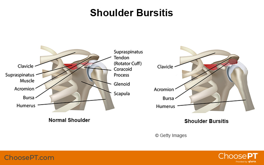 Illustration of Shoulder Bursitis