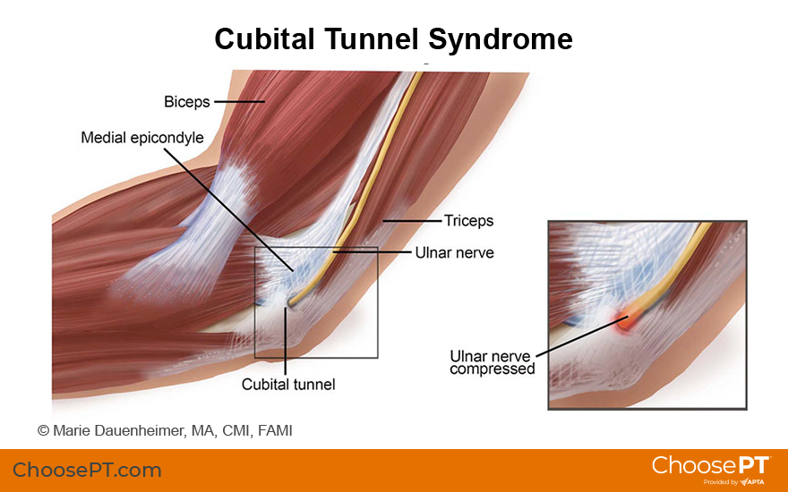 Illustration for cubital tunnel syndrome