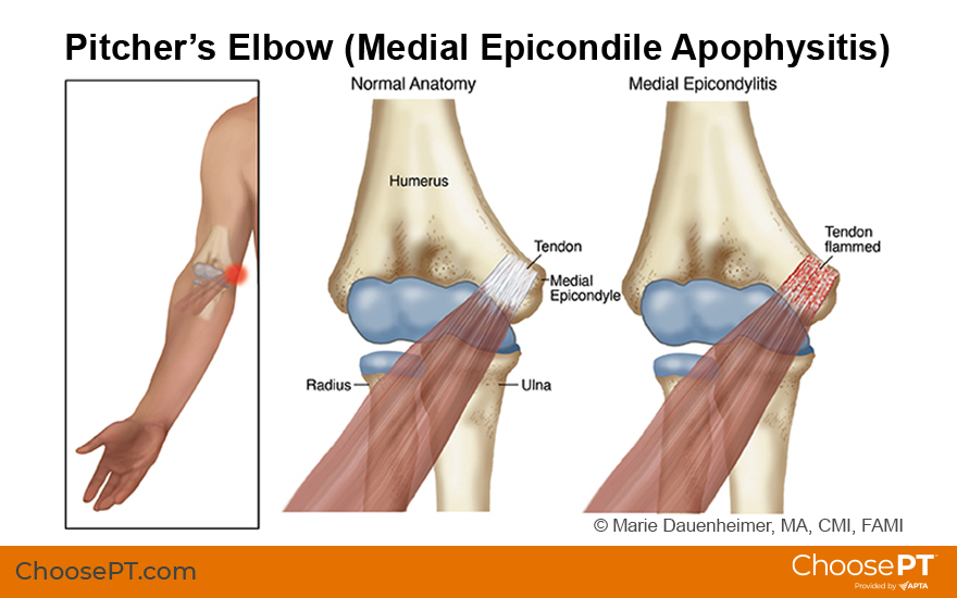 Illustration of pitcher's elbow (medial epicondylitis)