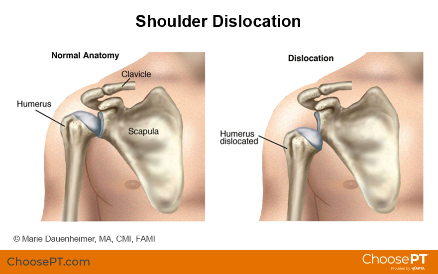 Illustration of shoulder dislocation