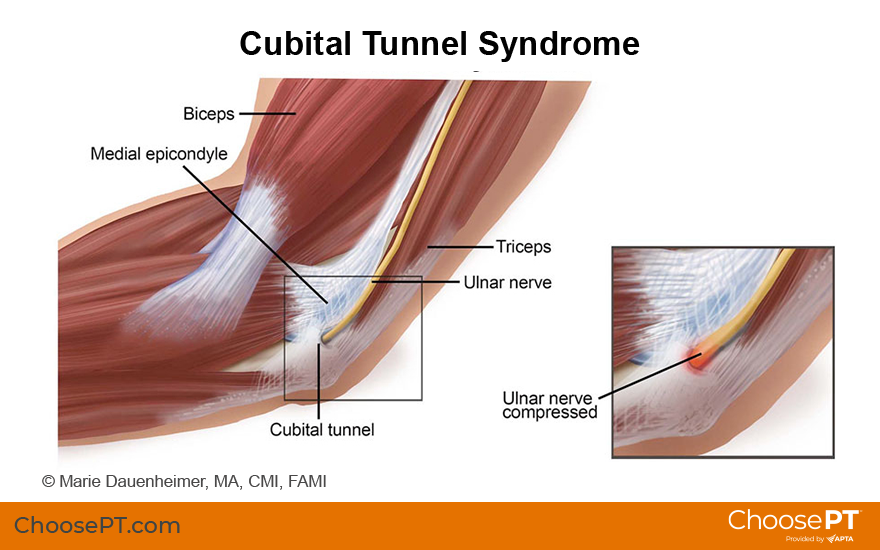 Illustration for cubital tunnel syndrome