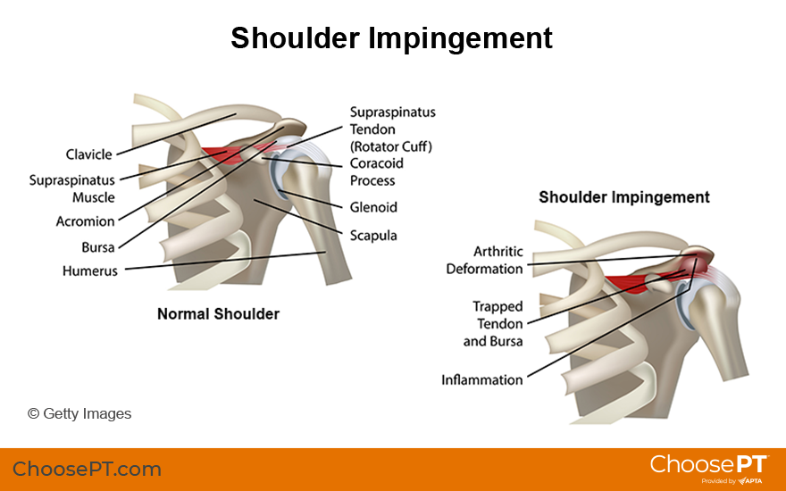 Illustration of shoulder impingement syndrome