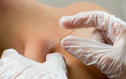 A physical therapist performing dry needling on a patient.