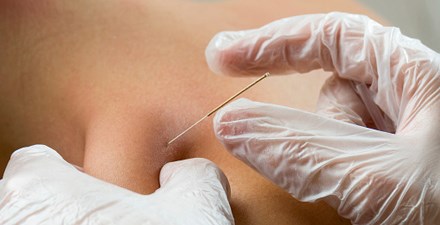 A physical therapist performing dry needling on a patient.