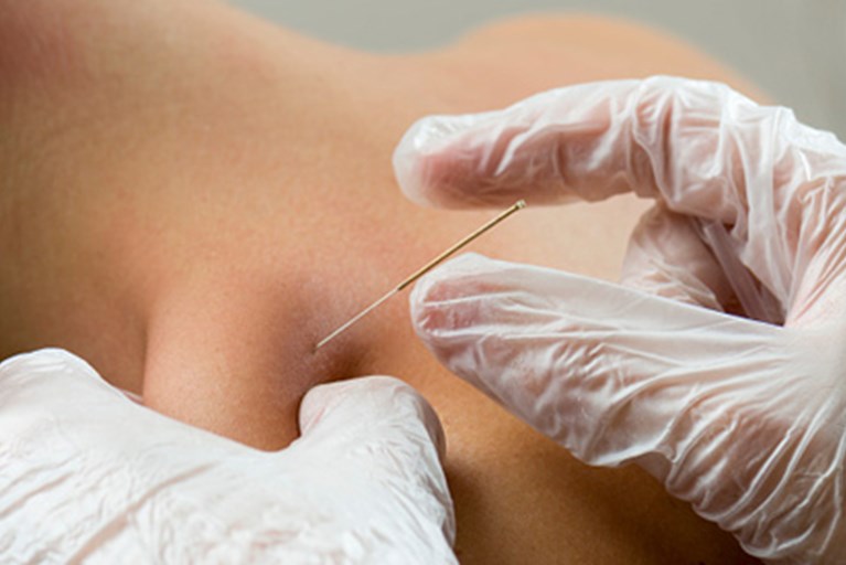 A physical therapist performing dry needling on a patient.