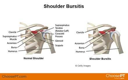 Guide | Physical Therapy Guide to Shoulder Bursitis | Choose PT