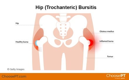 Guide | Physical Therapy Guide to Hip Bursitis | Choose PT