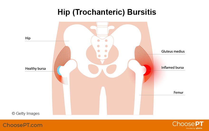 Illustration of hip bursitis