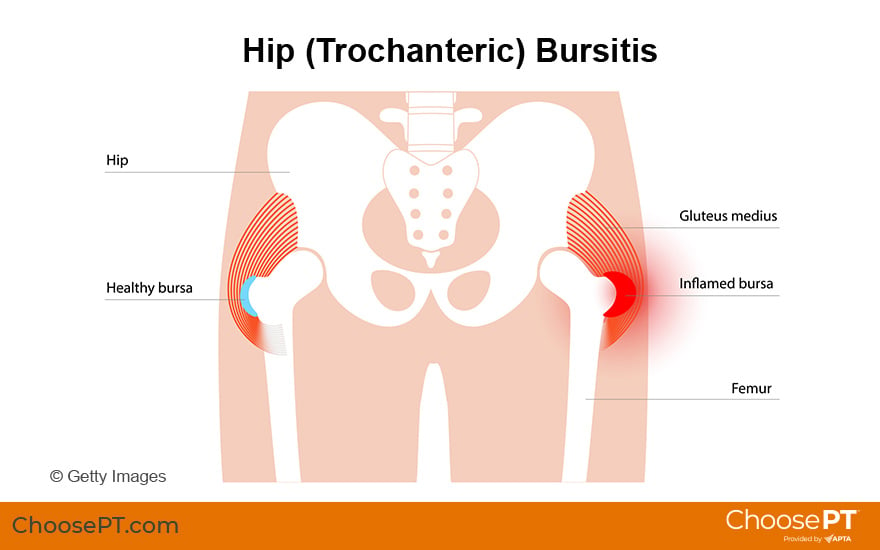 Hip Bursitis  Symptoms, Treatments, & Prevention