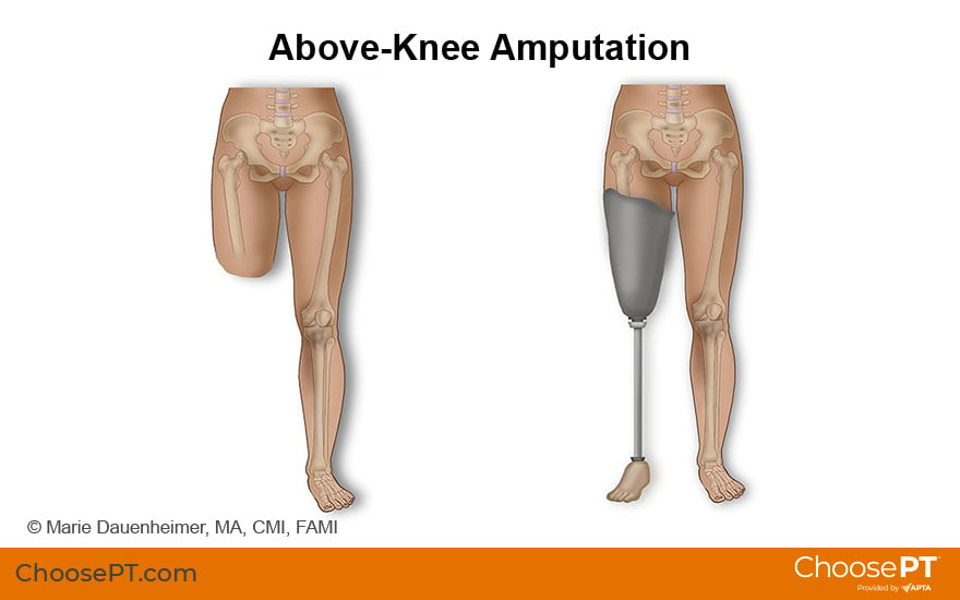 Above-Knee Amputation Illustration