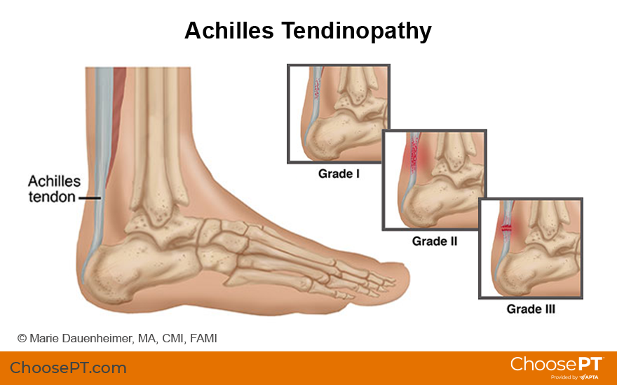 Illustration of achilles tendinopathy