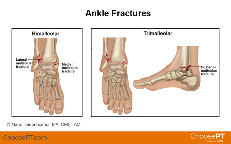 Illustration of Ankle Fractures