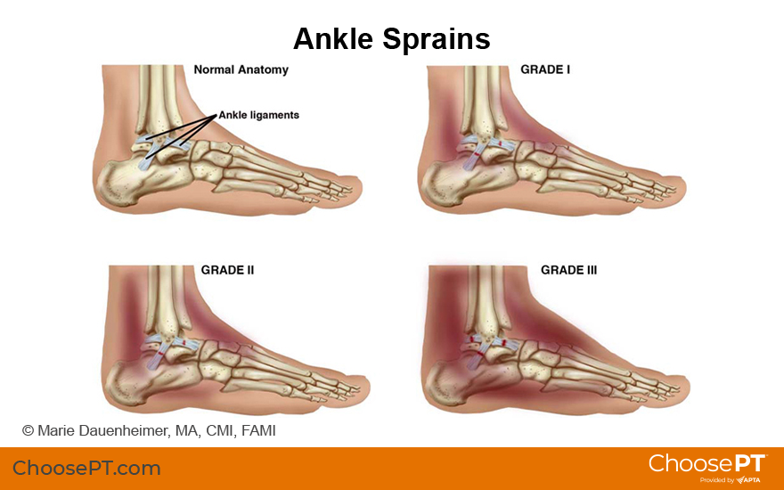 Illustration of ankle sprains
