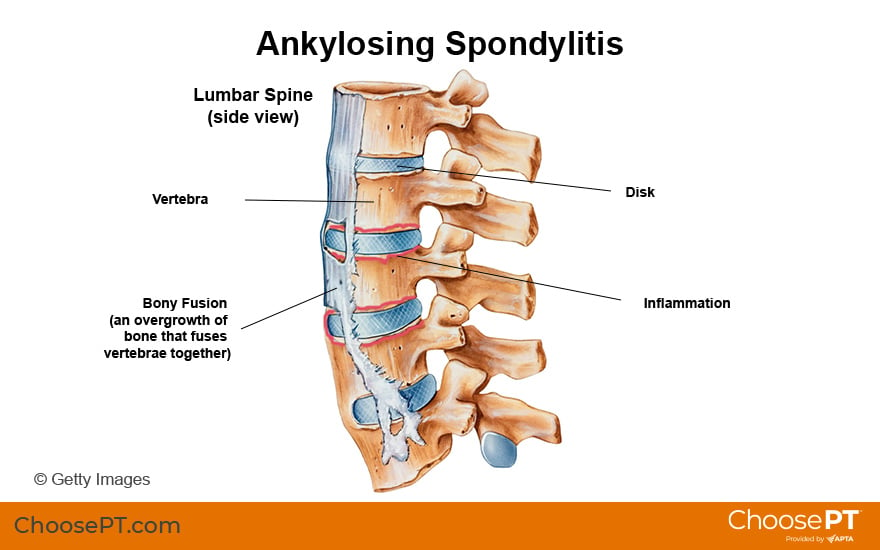Illustration of Ankylosing Spondylitis