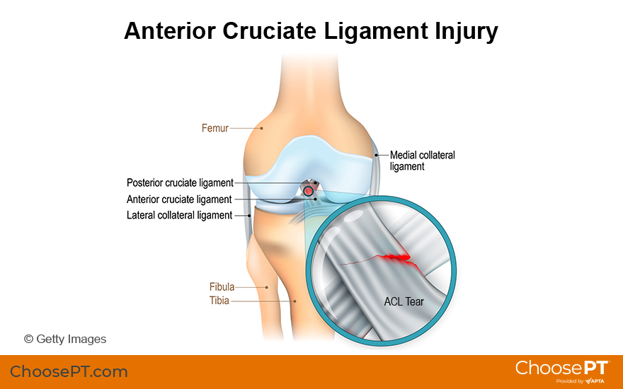 Illustration of Anterior Cruciate Ligament Injury