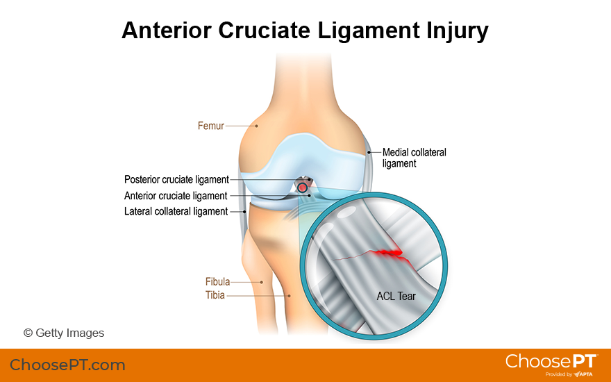 Guide, Physical Therapy Guide to Anterior Cruciate Ligament Tear