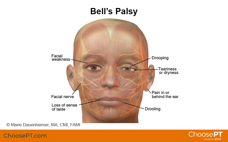 Illustration of Bell's palsy