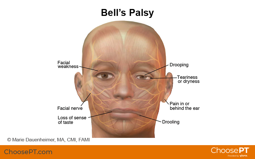 Bells palsy adalah