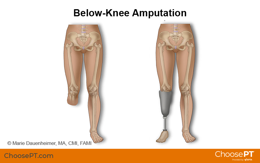 Illustration of below the knee amputation