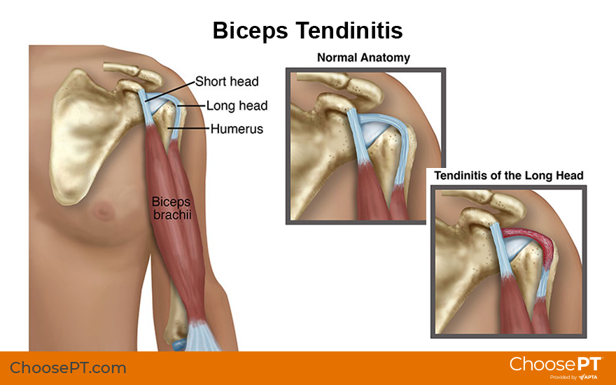 Illustration of biceps tendinitis