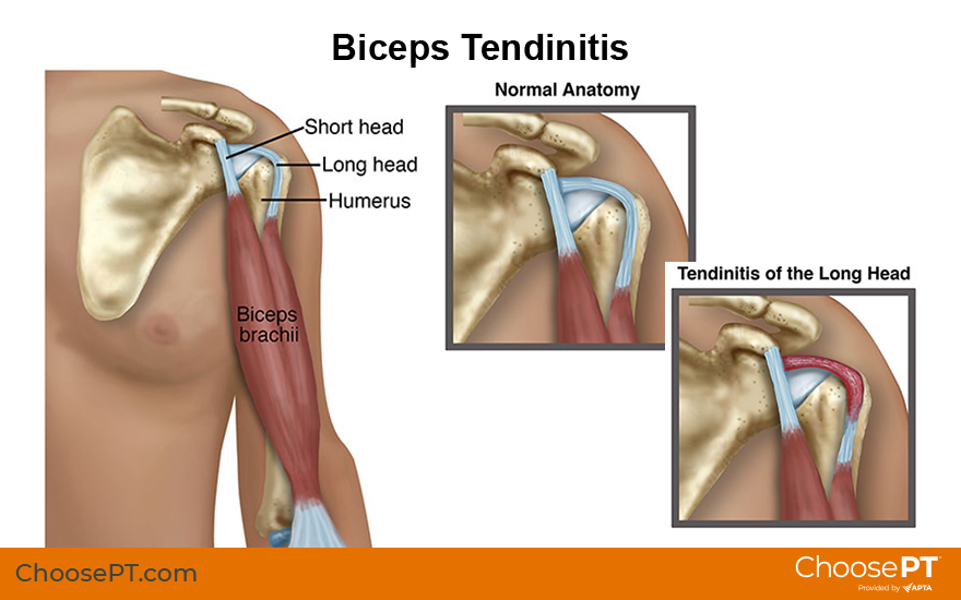 Bicep tendonitis shop