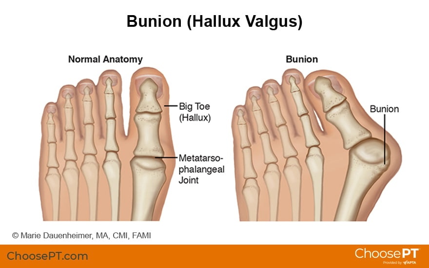 Illustration of Bunion (Hallux Valgus)