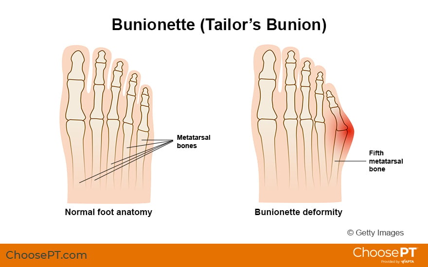 Illustration for Bunionette (Tailor's Bunion)