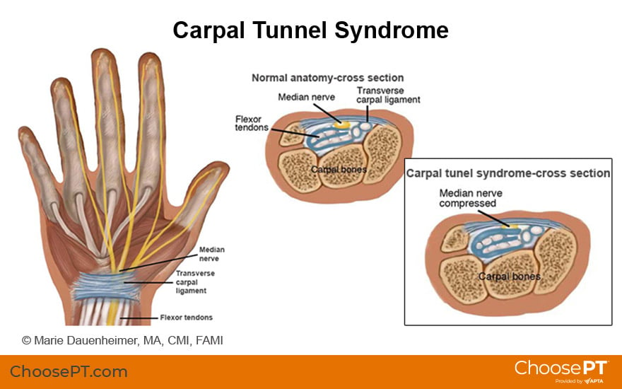 Guide, Physical Therapy Guide to Carpal Tunnel Syndrome