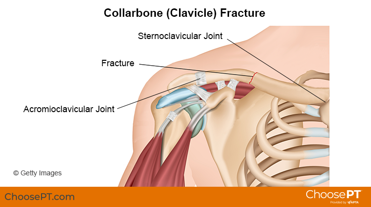 clavicle bone fracture