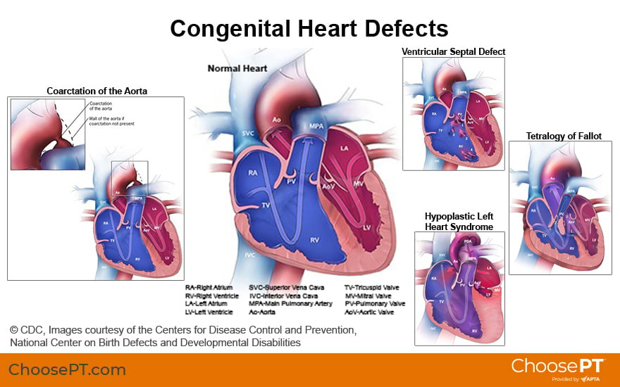 congenital heart disease