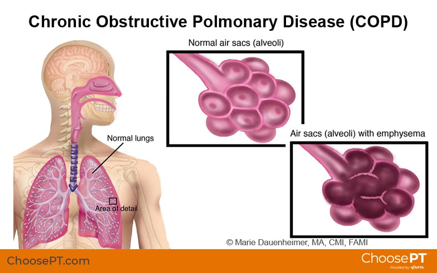 COPD Illustration