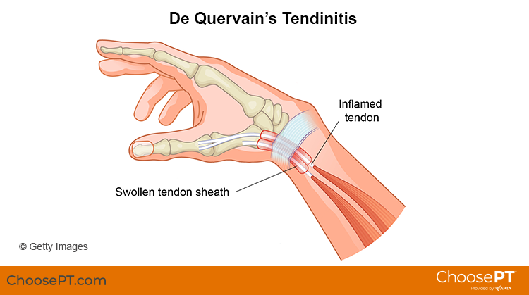 Illustration of de quervain's tendinitis