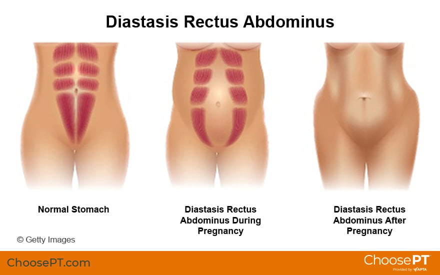 Postnatal Diastasis Recti: A Guide to Exercise and Nutrition