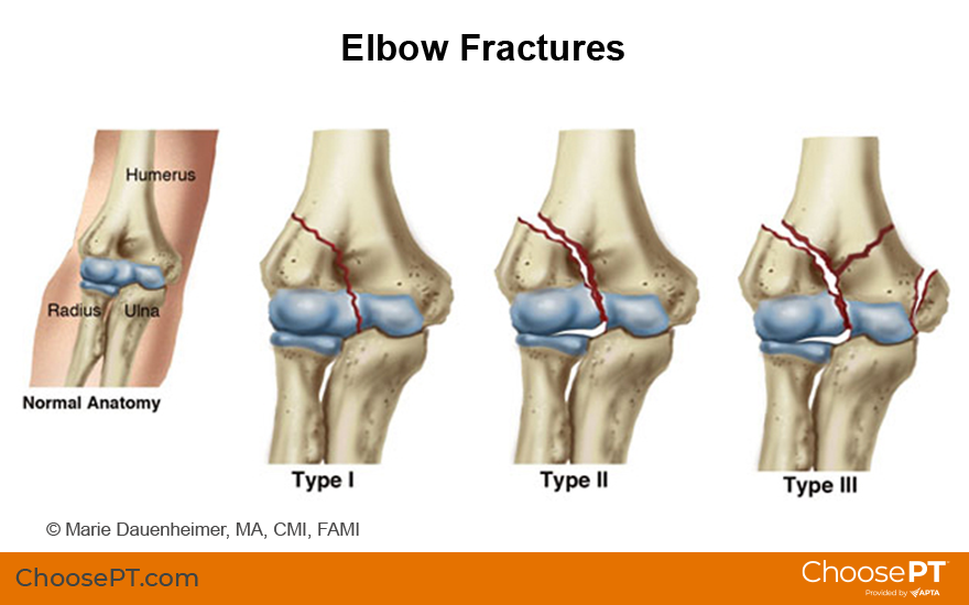 Illustration of elbow fractures