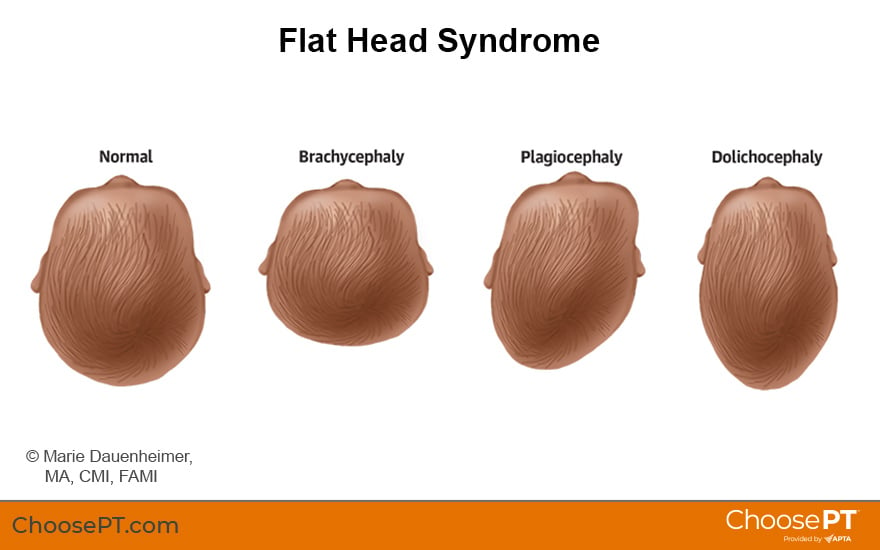 Illustration of Flat Head Syndrome