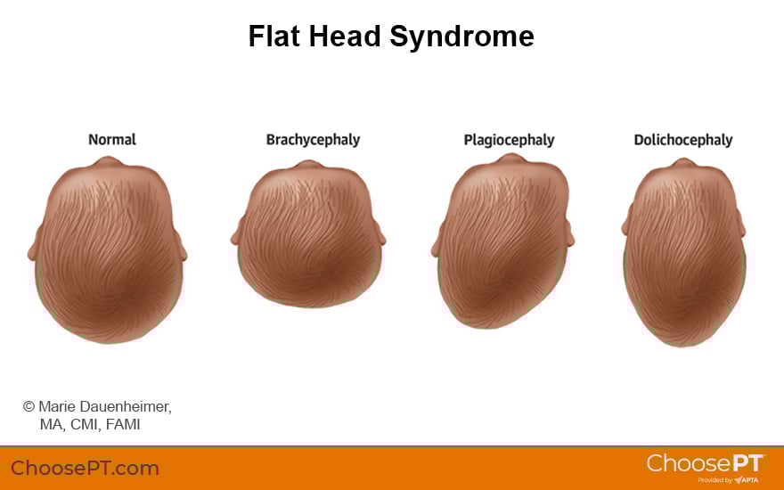 Guide | Physical Therapy Guide to Flat Head Syndrome: Plagiocephaly