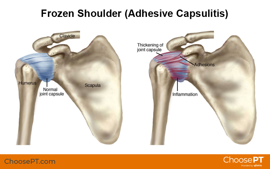 Guide Physical Therapy Guide to Frozen Shoulder (Adhesive Capsulitis