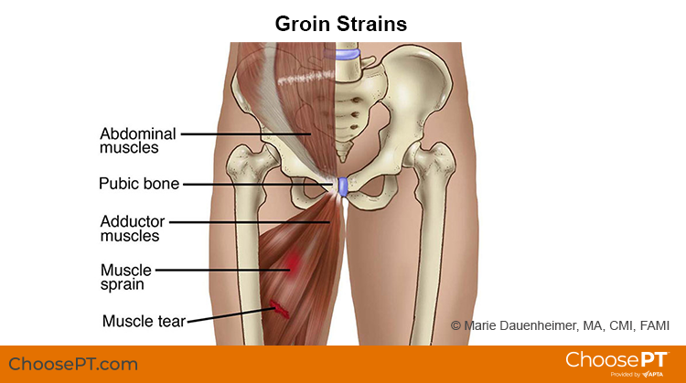 https://www.choosept.com/globalassets/choosept/assets/guide-illustrations-images/groin_strain_choosept_illustration.png.png