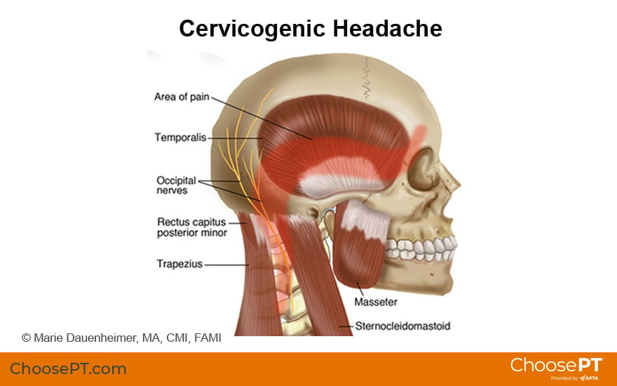 Guide Physical Therapy Guide To Headaches Choose Pt