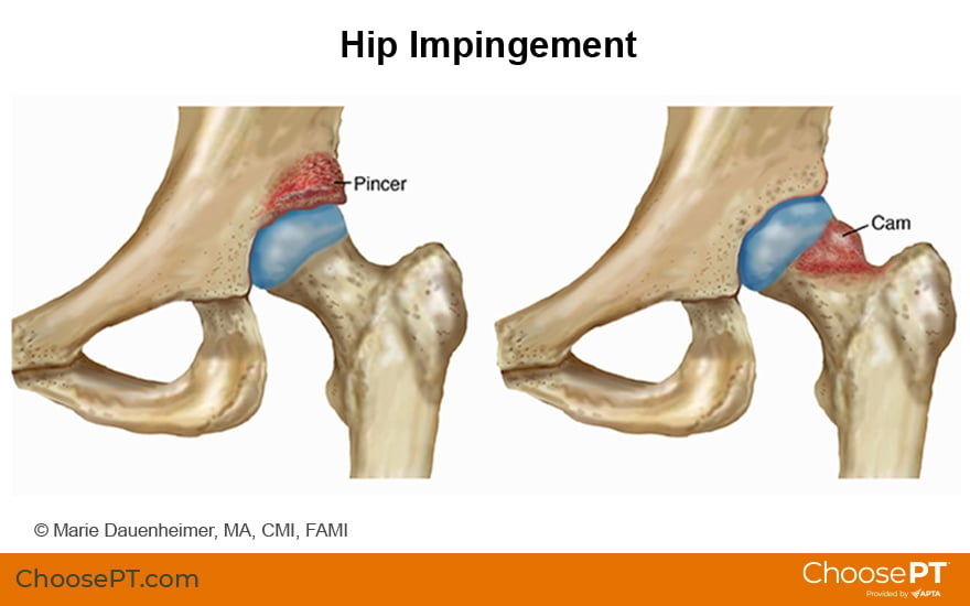 Illustration of hip impingement