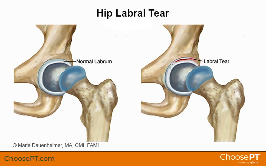 Illustration of Hip Labral Tear