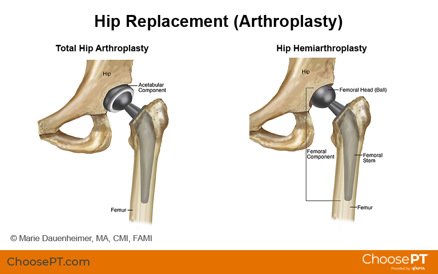 Guide  Physical Therapy Guide to Total Hip Replacement