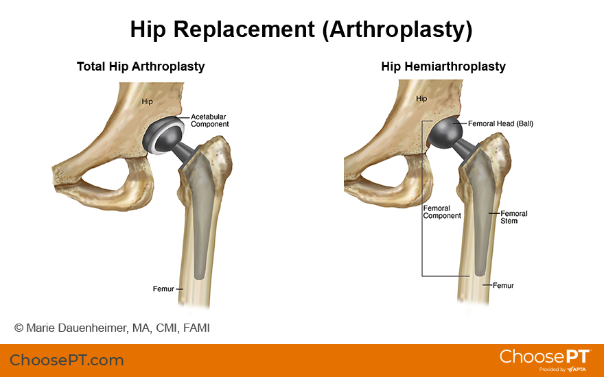 What to Know About a Total Hip Arthroplasty: Procedure, Recovery, More