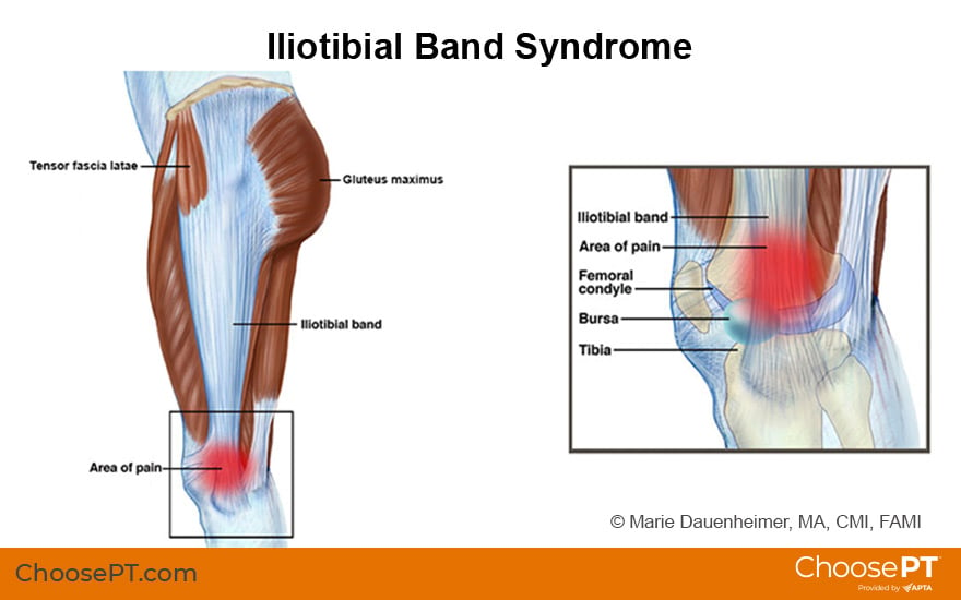 Illustration of Iliotibial Band Syndrome