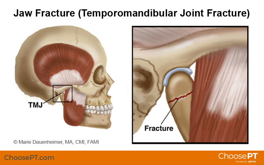 Recovery skull time fracture 