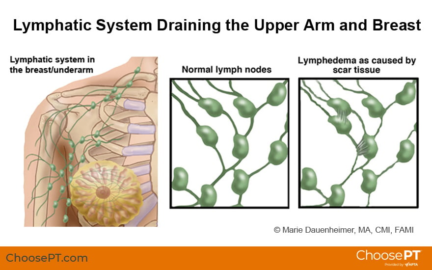 Illustration of Lymphedema