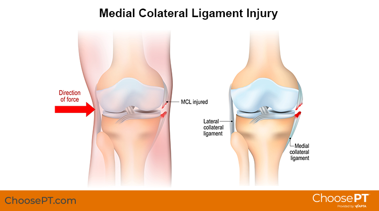 Illustration of a medial collateral ligament injury