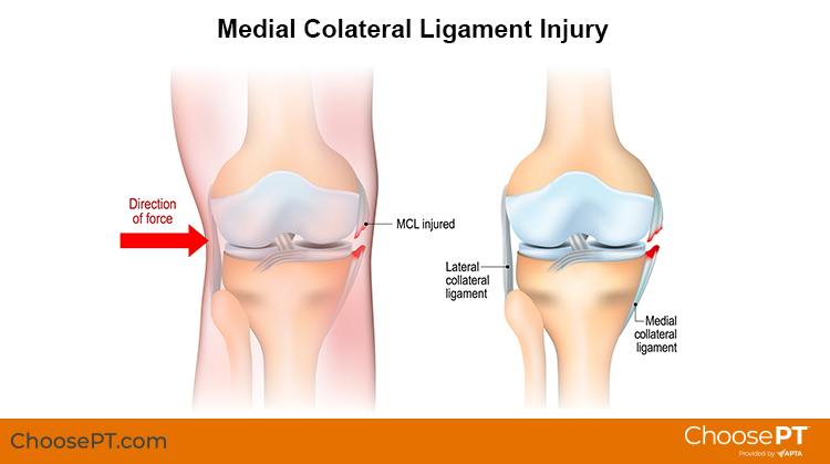 Medial Collateral Ligament (MCL) Sprain - Fantasy Injury Team