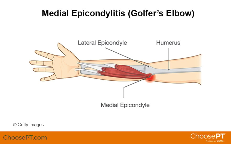 Illustration of Golfer's Elbow