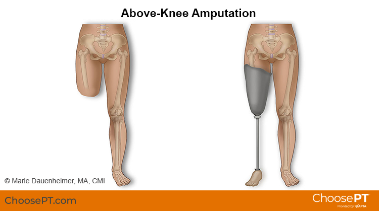 Types of prosthetic legs above the knee